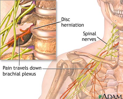 Rolfing helps relieve nerve pain
